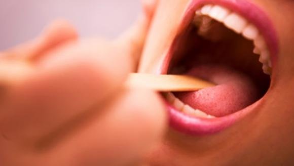 Placche alla gola: cosa sono, cause, cure e rimedi naturali