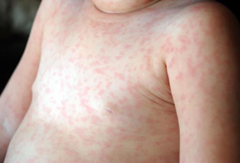 Le papule e le macchie rosse sul corpo del bambino con la sesta malattia