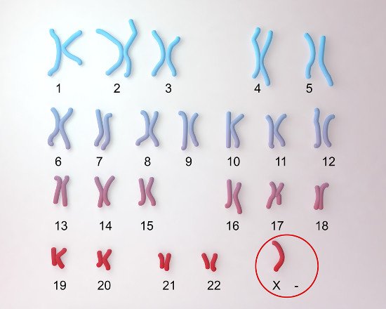 La sindrome di Turner è dovuto ad un mancato sviluppo del cromosoma XX