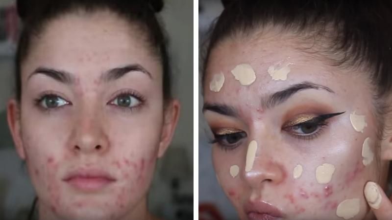 Inizia a truccare il suo viso rovinato dall’acne. La trasformazione è davvero sorprendente!