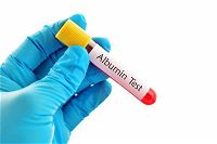 Albumina alta o bassa nel sangue: cause, valori normali e cure