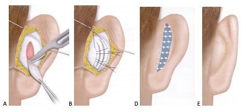 L'otoplastica è l'unica soluzione definitiva per risolvere il problema delle orecchie a sventola