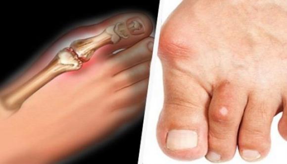 Come eliminare l’acido urico dal corpo e ridurre gotta e dolori articolari in modo naturale