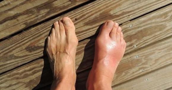 Come eliminare l’acido urico dal corpo e ridurre gotta e dolori articolari in modo naturale