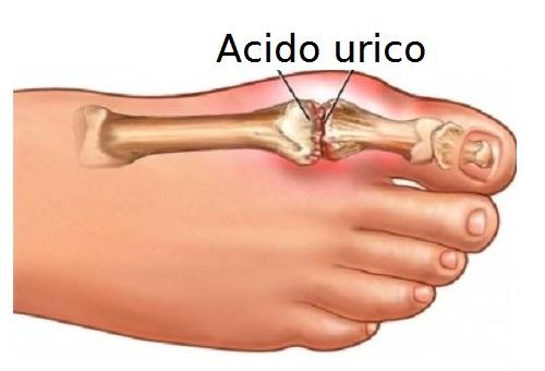 Come eliminare l’acido urico dal corpo e ridurre gotta e dolori articolari in modo naturale