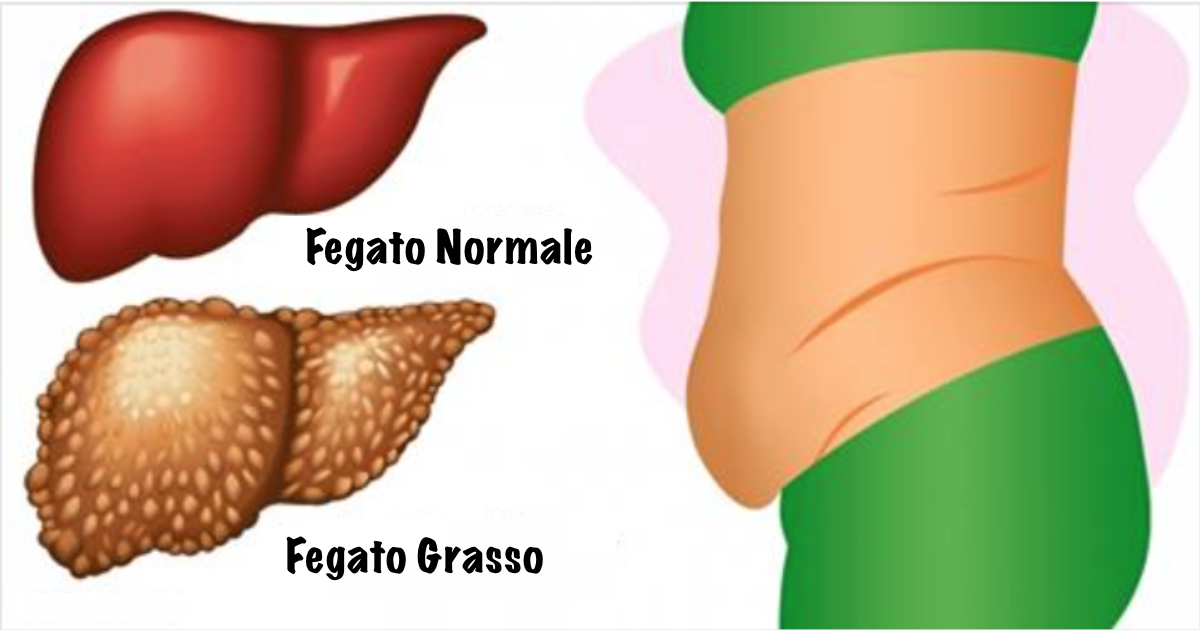 Questi sintomi indicano che il tuo fegato è saturo di tossine