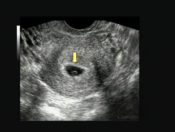Nel corso della quarta settimana di gravidanza si può fare la prima ecografia, dalla quale si vede un piccolo puntino ricoperto dal sacco gestazionale
