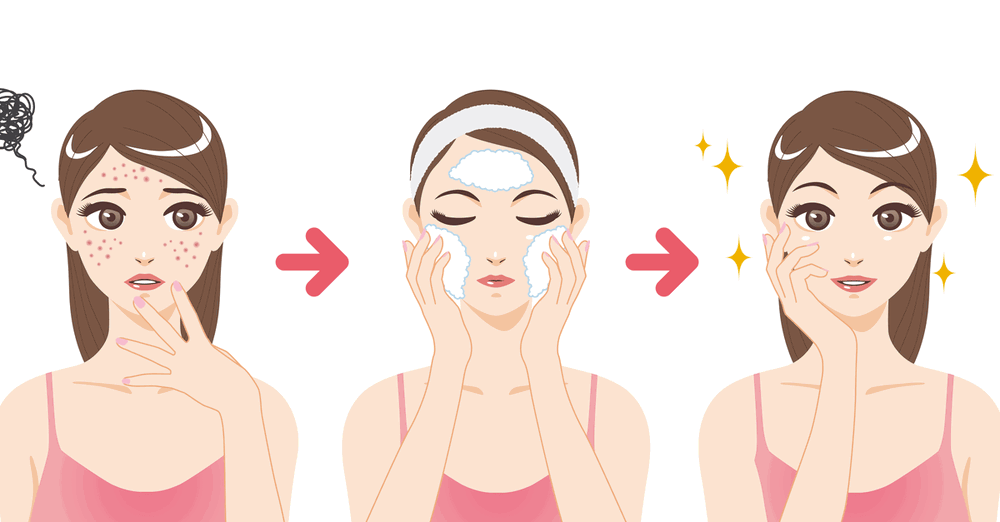 Ecco come prevenire e curare l’acne