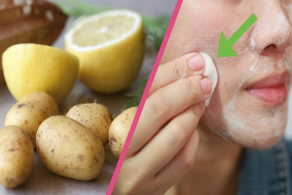 Ecco come usare le patate per sbarazzarsi dei punti neri senza effetti collaterali