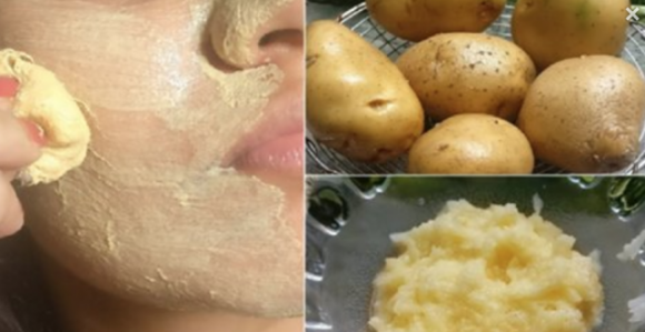 Ecco come usare le patate per sbarazzarsi dei punti neri senza effetti collaterali