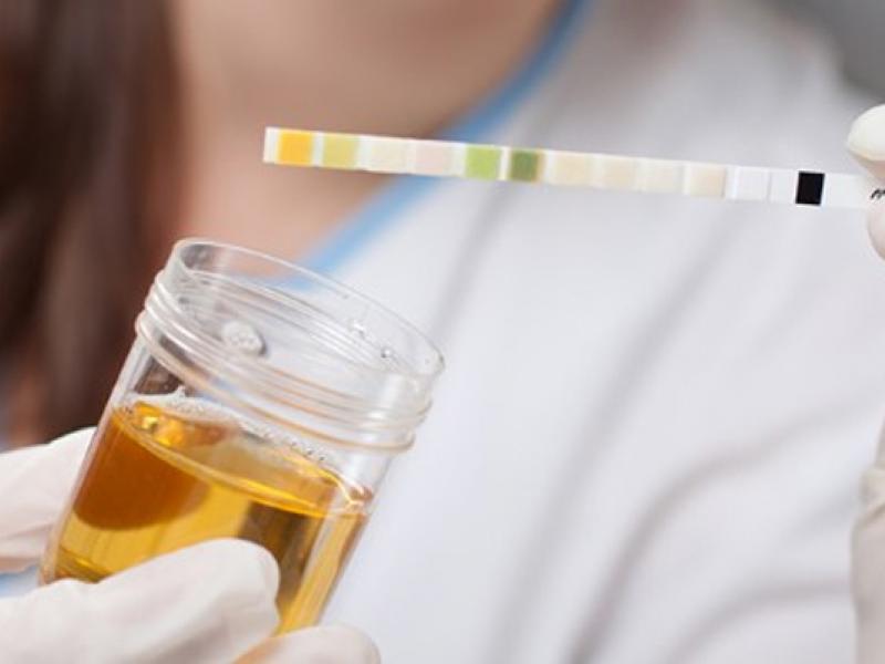 Albumina nelle urine: le cause e valori di riferimento