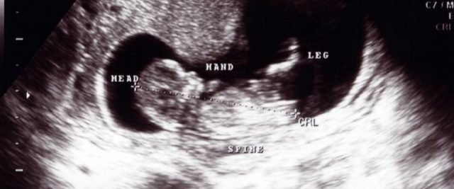 Effettuando l'ecografia durante la dodicesima settimana di gravidanza si nota come il feto si sia già formato