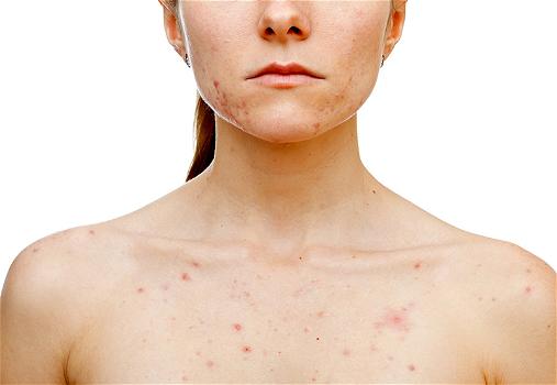 Puntini rossi sulla pelle: le cause principali, cura e rimedi naturali