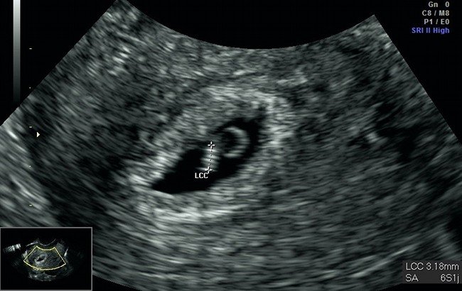 Uno dei momenti più emozionanti, della sesta settimana di gravidanza, è la prima ecografia
