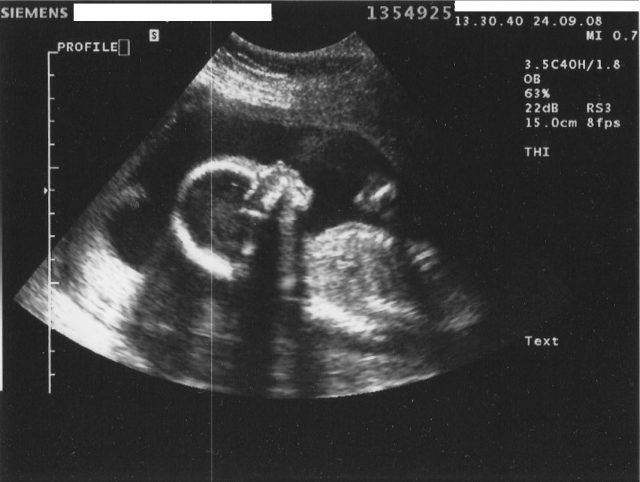 Nel corso dell'undicesima settimana di gravidanza si effettua l'ecografia perché il bambino inizia ad essere ben visibile