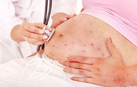 Varicella in gravidanza: cosa fare, cura e i rimedi naturali