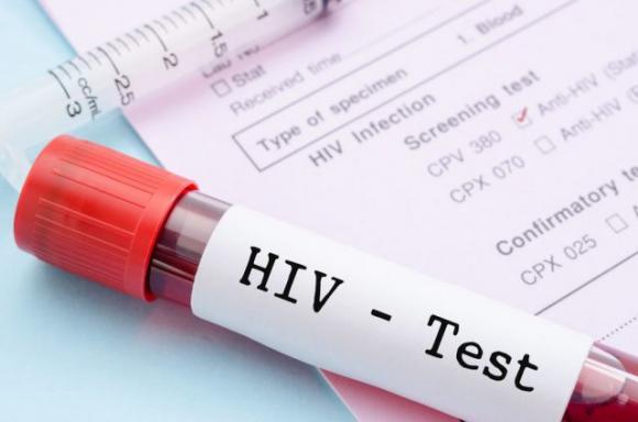 Ecco alcuni sintomi dell’HIV