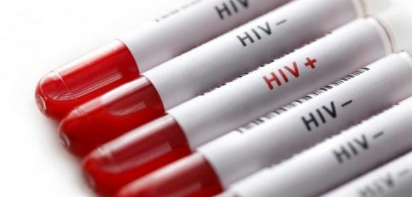 Ecco alcuni sintomi dell’HIV