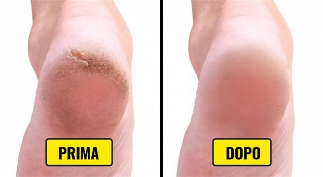 Ecco dei rimedi per evitare i talloni screpolati e mantenere belli i vostri piedi
