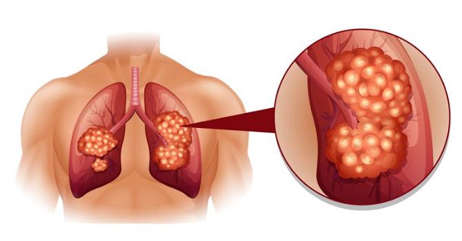 Ecco alcuni sintomi gravi per la salute dei vostri polmoni