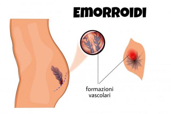 Ecco come sbarazzarsi delle emorroidi