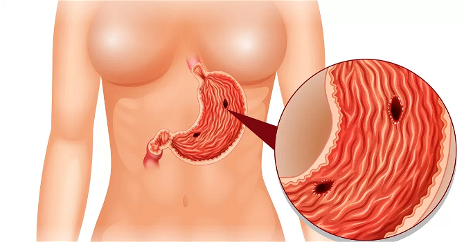 Ecco alcuni modi per evitare l’infiammazione di un’ulcera