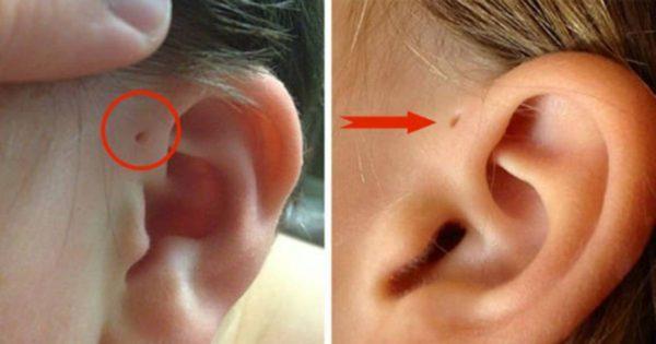 Il motivo affascinante per cui alcune persone hanno un piccolo foro sopra l’orecchio