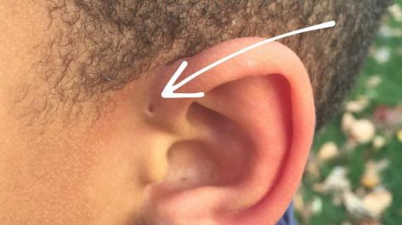 Il motivo affascinante per cui alcune persone hanno un piccolo foro sopra l’orecchio