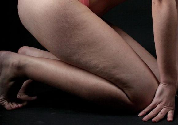Come liberarsi dalla cellulite in maniera naturale, sana e definitiva!