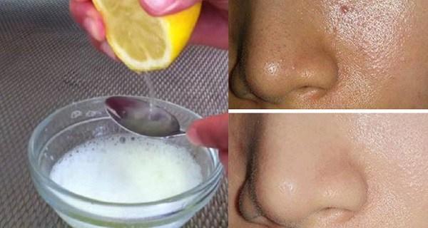 Utilizzando questi 2 ingredienti puoi dimenticare acne, brufoli e punti neri e il tuo viso sarà più pulito!