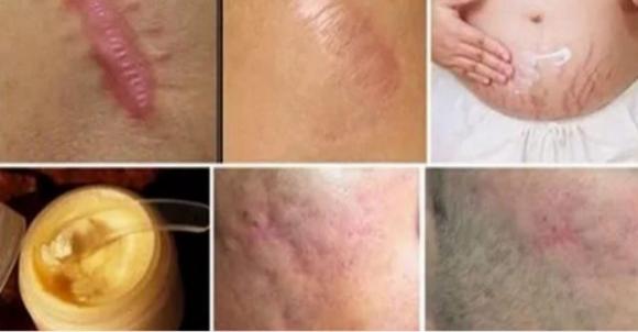 Rimuovi le cicatrici da qualsiasi parte del corpo in meno di un mese
