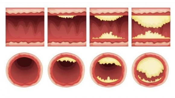 7 rimedi naturali per pulire le arterie e salvarti la vita