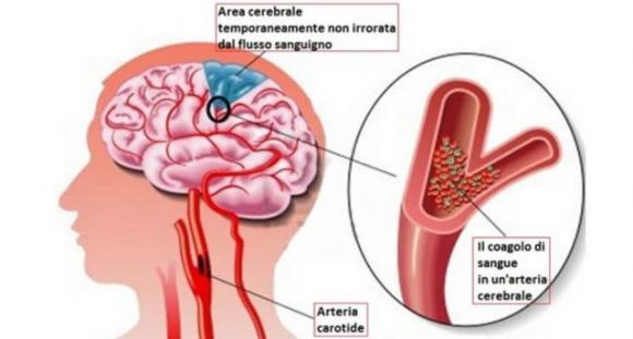Un mese prima di un attacco di cuore il tuo corpo ti avvertirà con questi 8 segnali