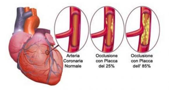 Un mese prima di un attacco di cuore il tuo corpo ti avvertirà con questi 8 segnali