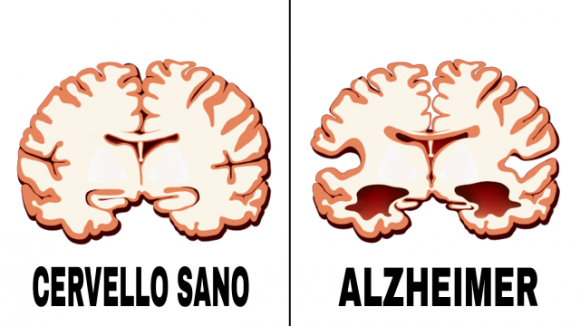 Gli scienziati spiegano come l’ansia influenza le probabilità di sviluppare il morbo di Alzheimer