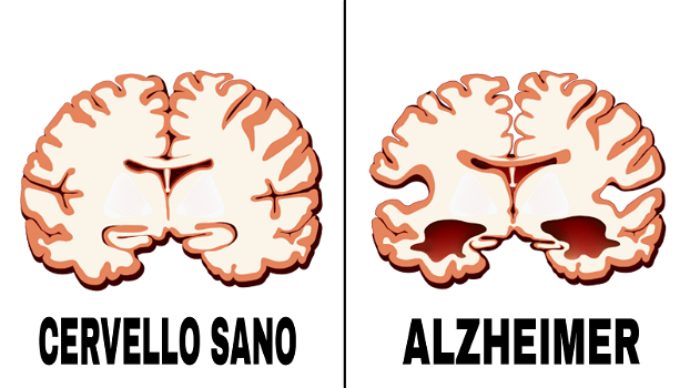 Gli scienziati spiegano come l’ansia influenza le probabilità di sviluppare il morbo di Alzheimer