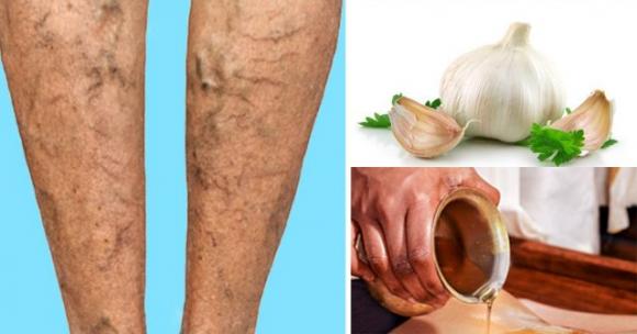 10 rimedi naturali ed esercizi per sbarazzarsi delle vene varicose