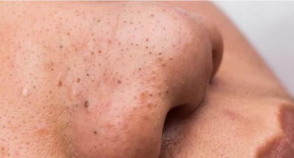 La magia del dentifricio sui punti neri: il trucchetto per una pelle perfetta