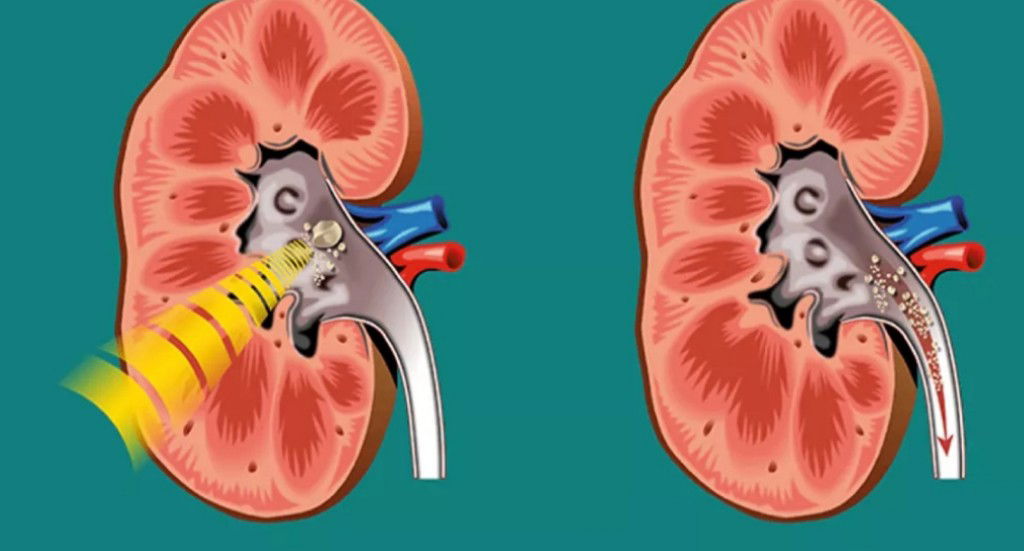 Un rimedio efficace per rimuovere i calcoli renali in 7 giorni