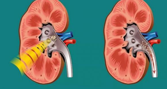 Un rimedio efficace per rimuovere i calcoli renali in 7 giorni