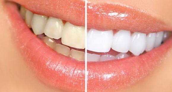 Avvolgi i denti con un foglio di alluminio e guarda cosa succede