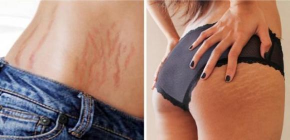Come prevenire le smagliature e cosa fare se già le hai