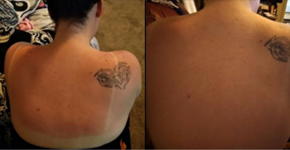 Una donna rivela la cura miracolosa di 30 minuti per le scottature solari e fa subito il giro del web!