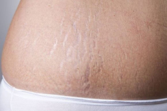 Come prevenire le smagliature e cosa fare se già le hai