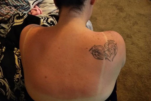 Una donna rivela la cura miracolosa di 30 minuti per le scottature solari e fa subito il giro del web!