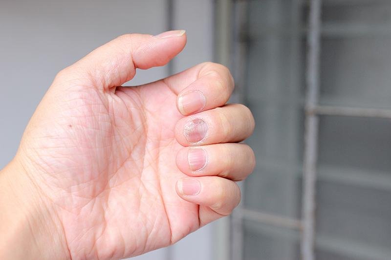 I funghi alle unghie possono determinare il dolore