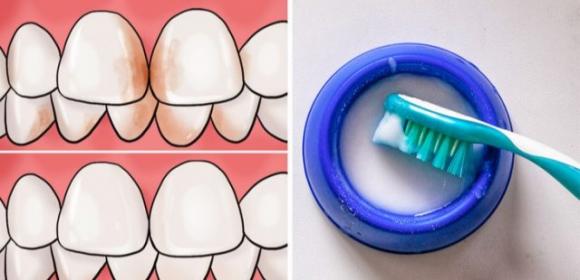 10 modi per rimuovere il tartaro accumulato sui denti