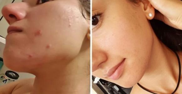 Una blogger mostra i cambiamenti sul suo viso quando ha ricominciato a mangiare carne dopo 4 anni di dieta vegana