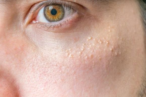 15 consigli per migliorare il contorno occhi, prevenire le rughe è meglio che curarle