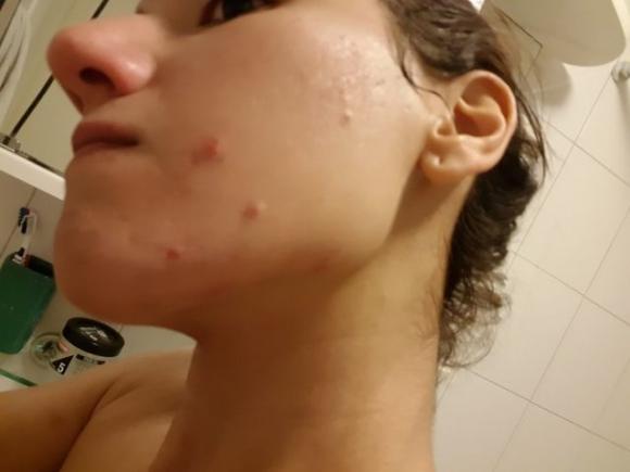 Una blogger mostra i cambiamenti sul suo viso quando ha ricominciato a mangiare carne dopo 4 anni di dieta vegana